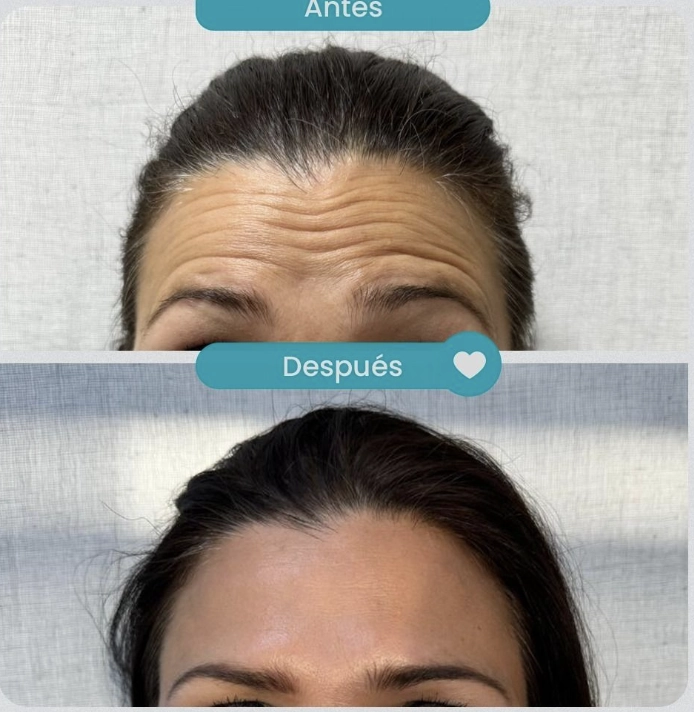 Tratamiento para signos de envejecimiento