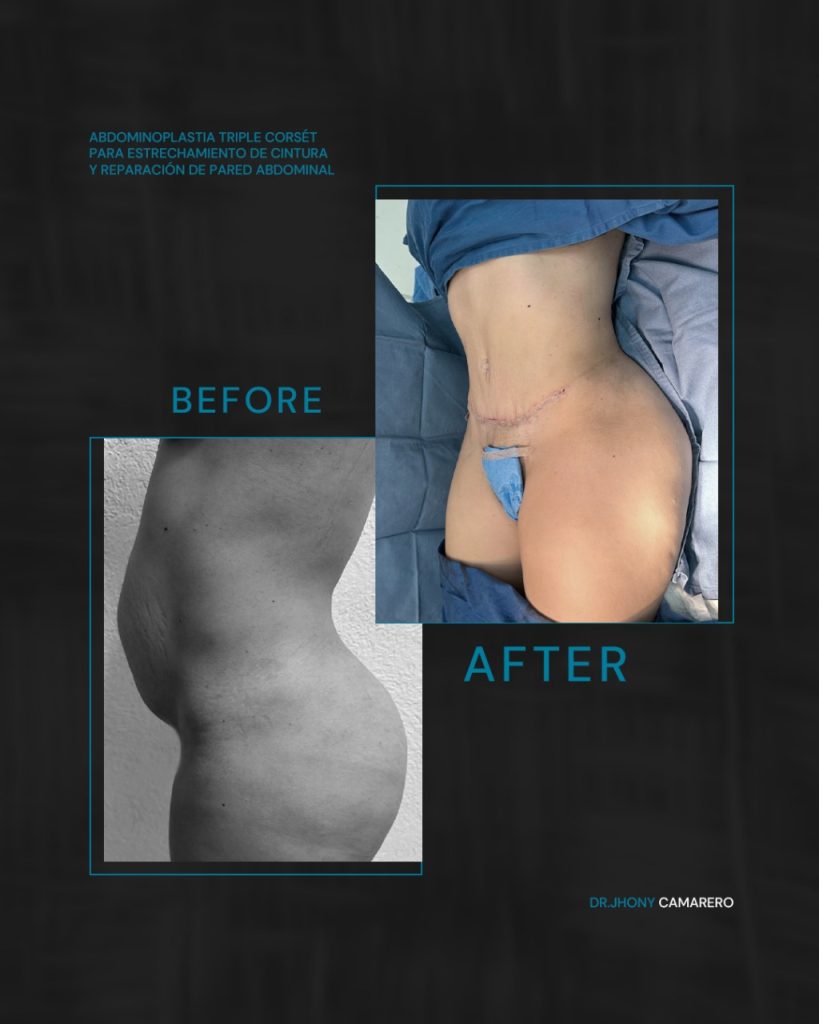 Abdominoplastia