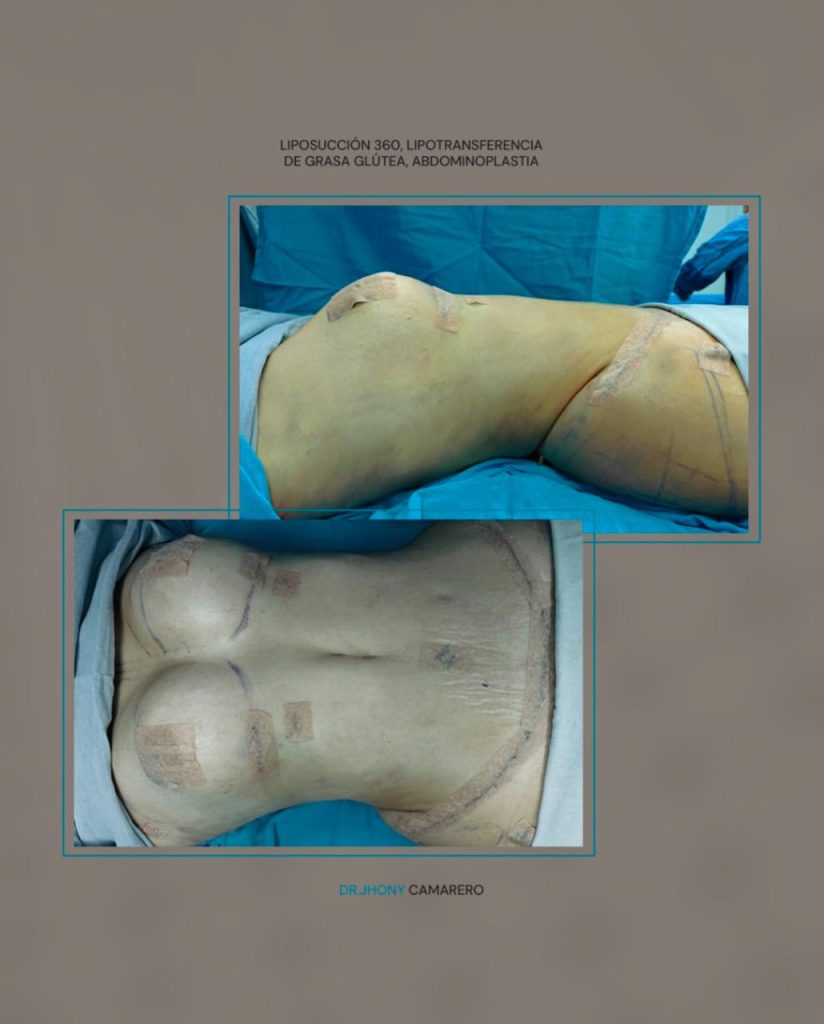 Abdominoplastia