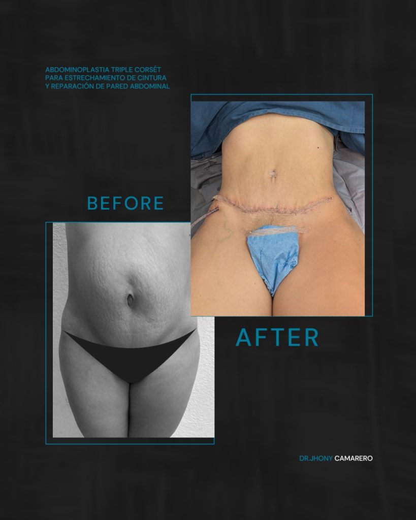 Abdominoplastia2