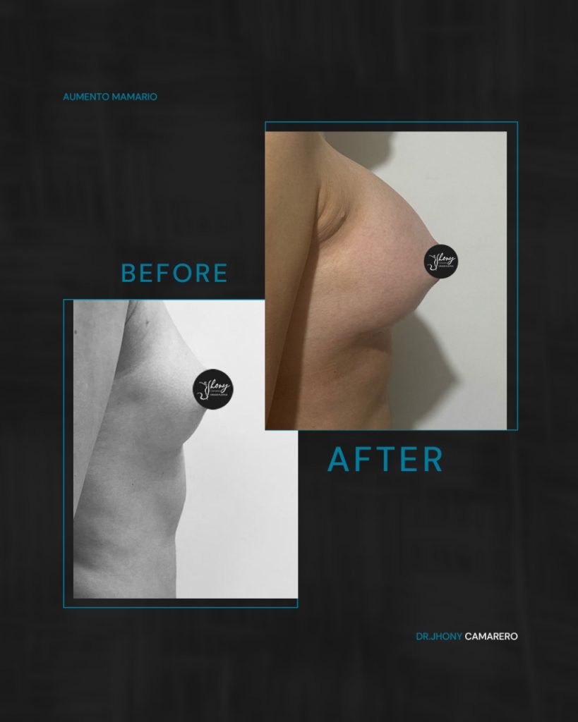 Aumento mamario