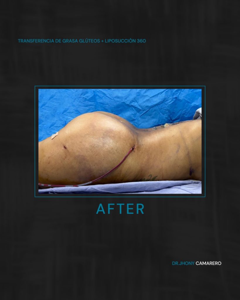 Lipo 360