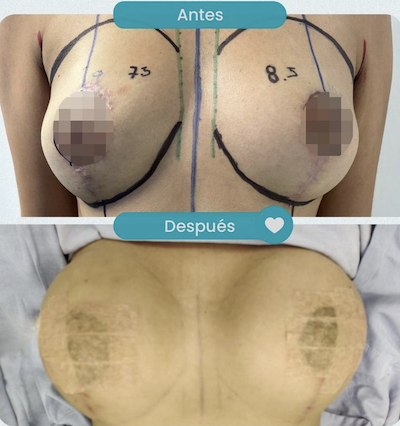 Resultados levantamiento de senos