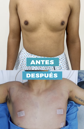 Resultados Ginecomastia reduccion mamaria hombres
