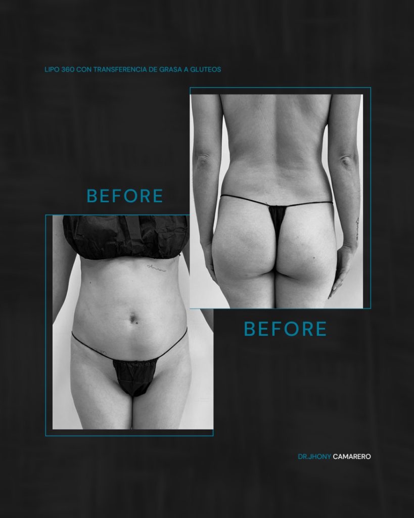 Resultados Lipo 360