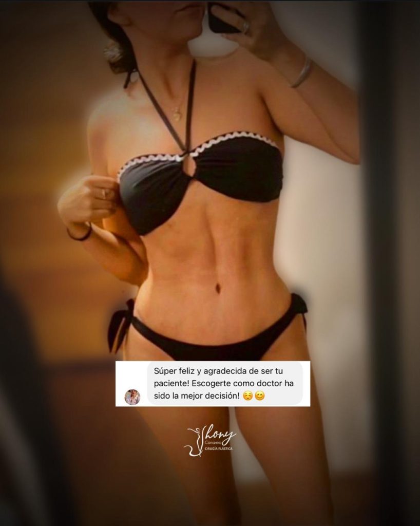 Resultados de mommy makeover