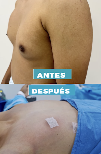 Resultados ginecomastia