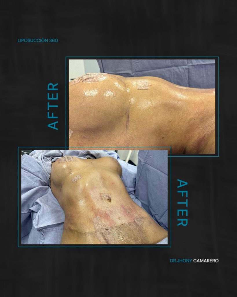 Resultados lipo HD