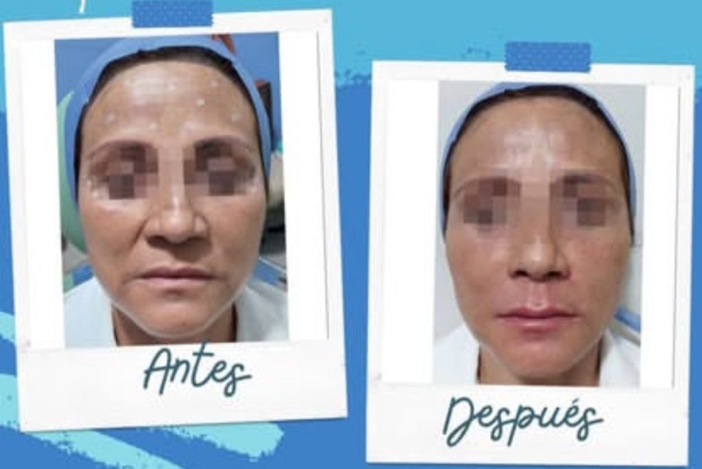 Resultados de lifting facial
