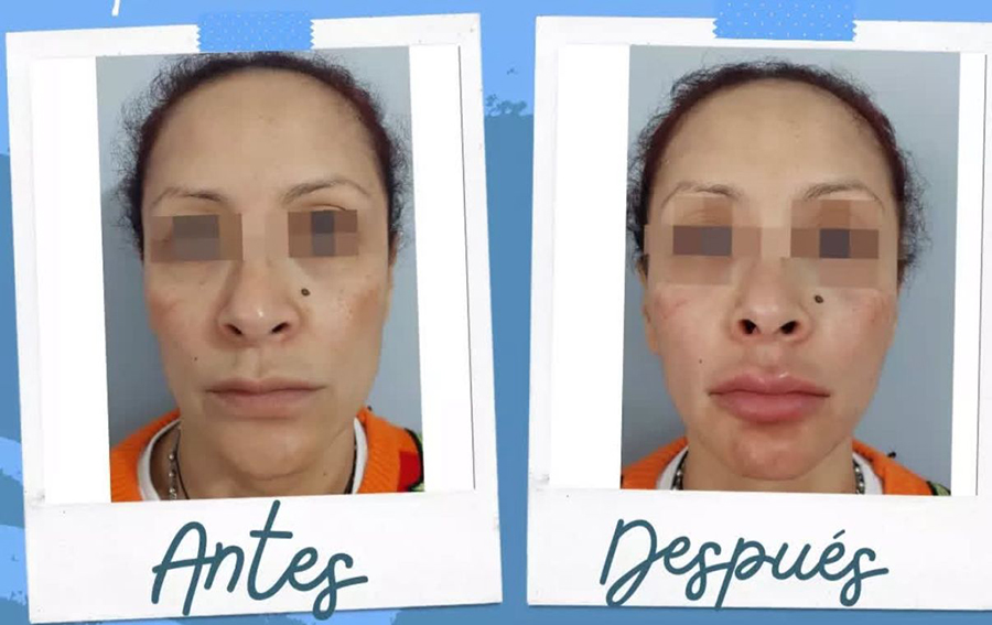 Resultados de lifting facial