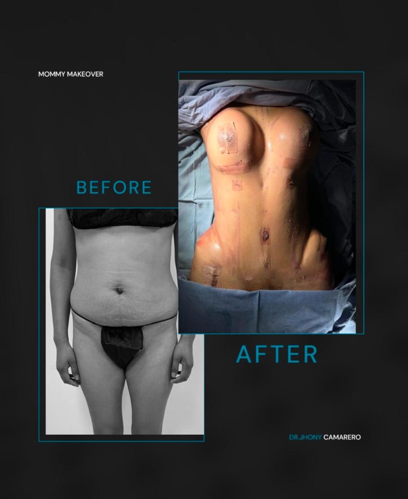 Resultado mommy makeover