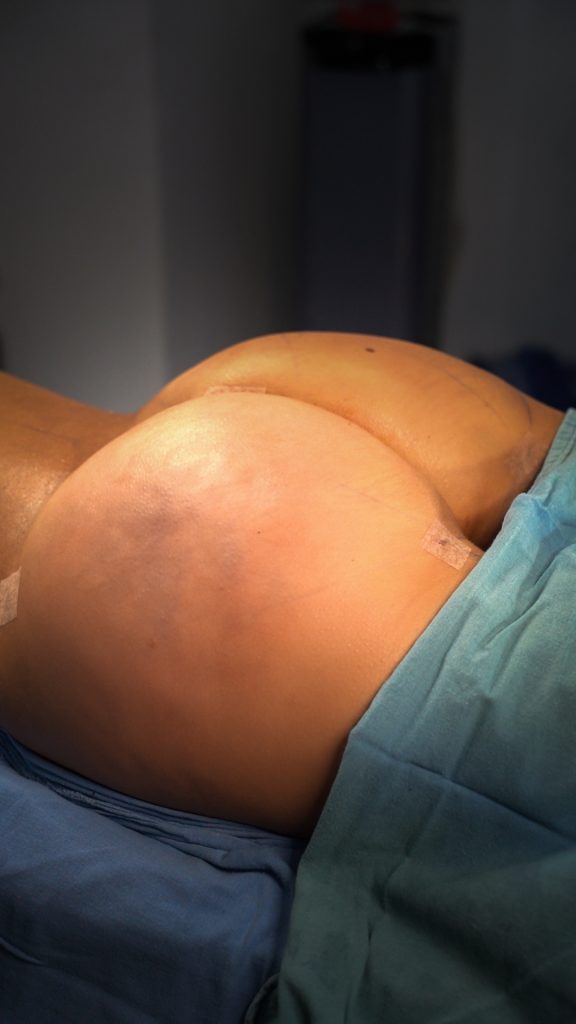 gluteoplastia