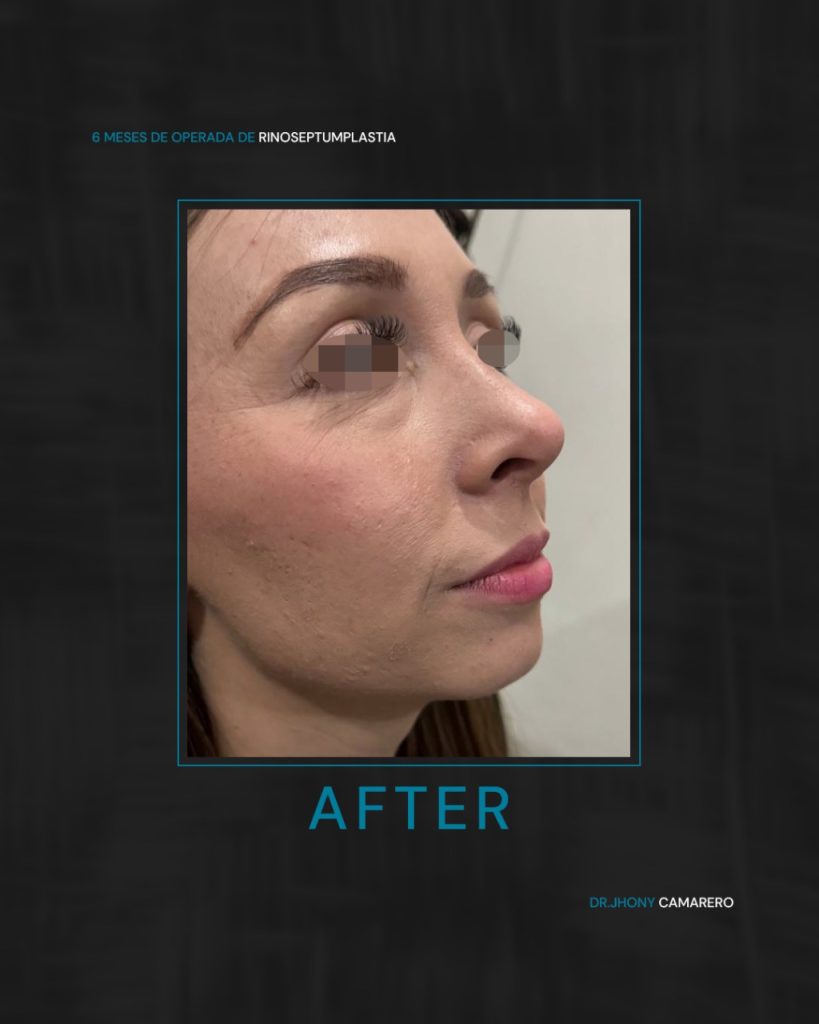 Resultados rinoplastia