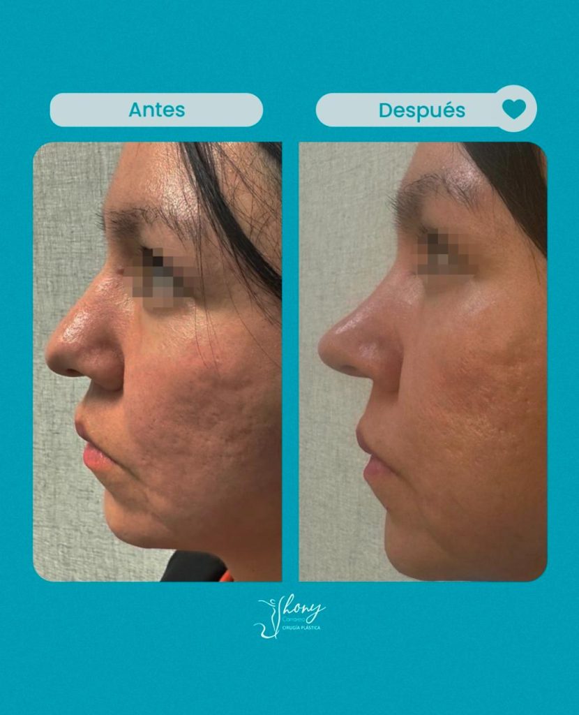 Rinoplastia resultados