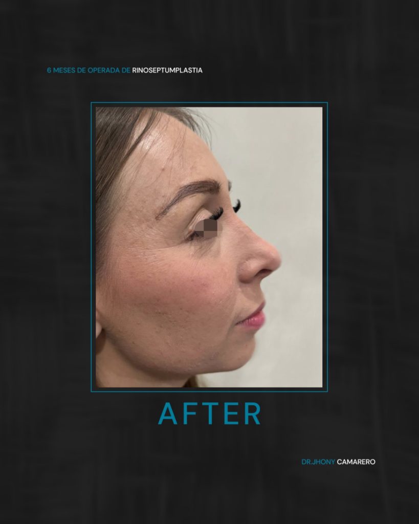 Rinoplastia resultados