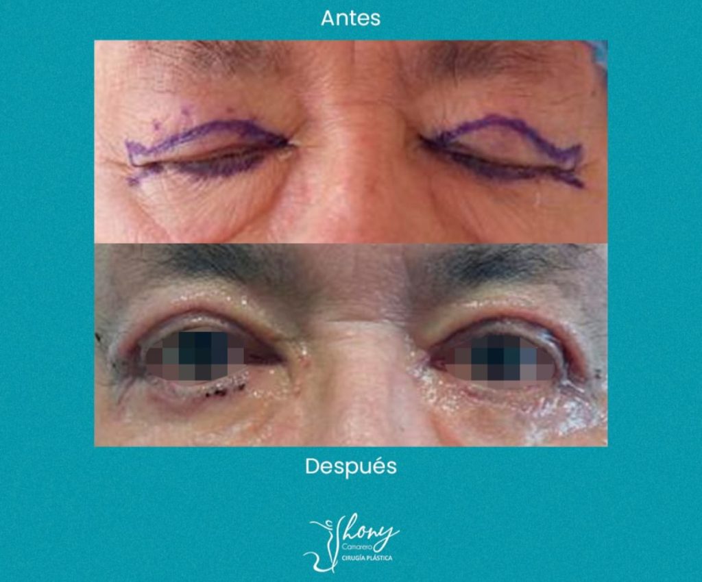 blefaroplastia